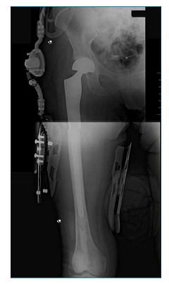 bari radiografica con protesi post intervento